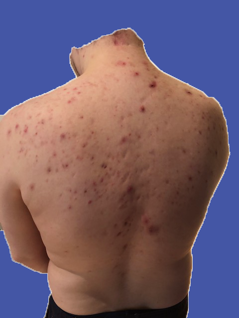 akne auf dem Rücken