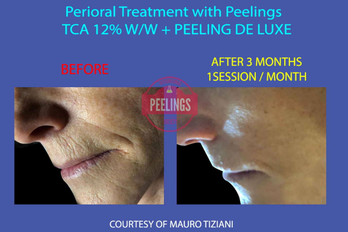 anti aging peel