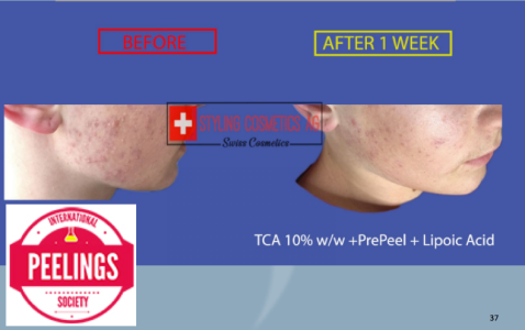 acne combination of peels