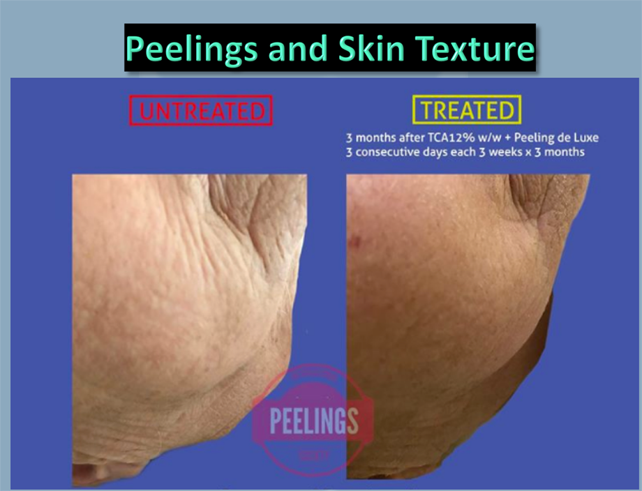 common peels
