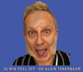 light chemical peel