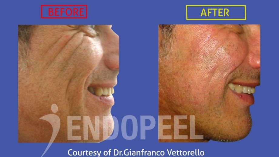 acne scars