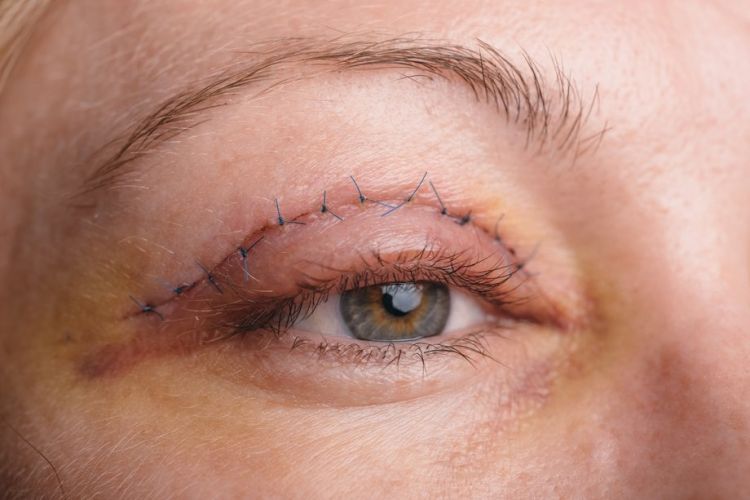 Blepharoplastik Naht