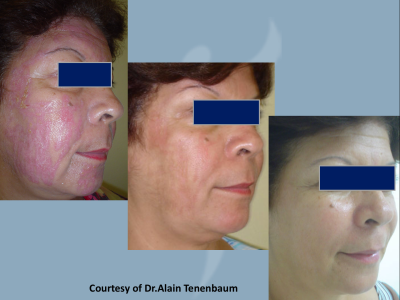 not dangerous deep peels